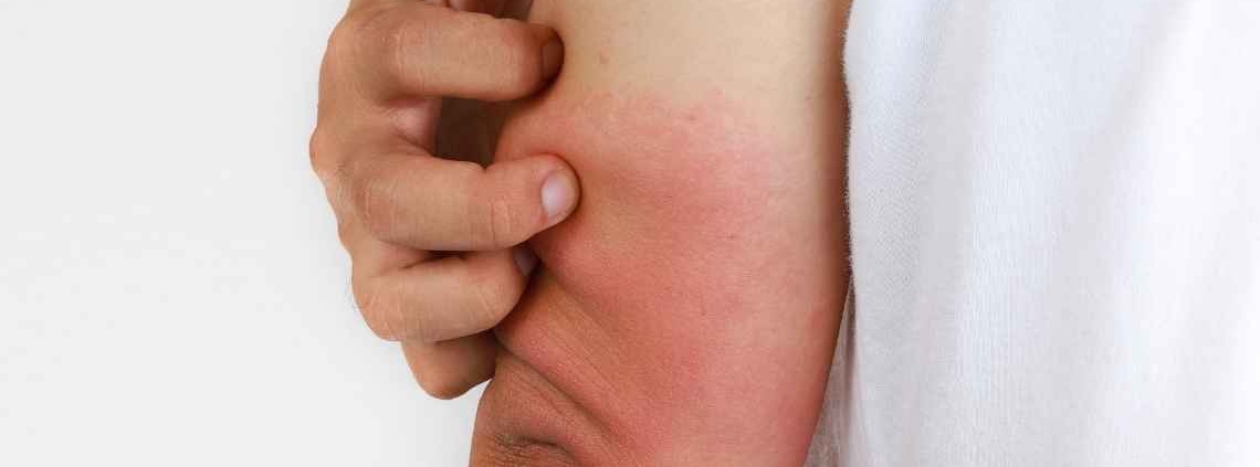 Erişkin Still Hastalığı Nedir?