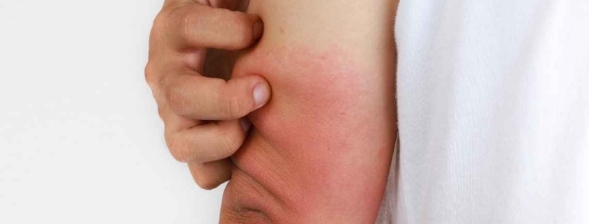 Erişkin Still Hastalığı Nedir?